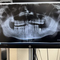 Brident Dental & Orthodontics - Upper and lower wisdom and bottom molar with implant