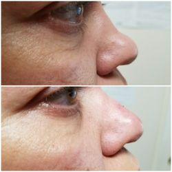 Medical Aesthetics - Non-surgical nosejob with Juvederm Voluma.