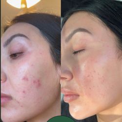 Face Reality Acne bootcamp clients results.