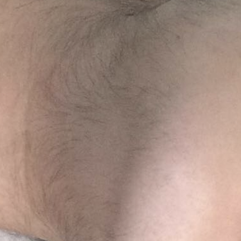 Boston Skin Solutions - Before Bridget - Hair Removal Near Me - Brookline, Massachusetts