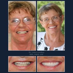 Bridgeview Dental - Smile Makeover Before & After
Dr. Lance Loveless, DDS, FAGD, LVIF
Dentist in Austin, TX
Bridgeview Dental
3801 N Capital of ...