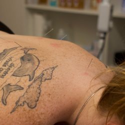 Tampa Heights Acupuncture - Acupuncture