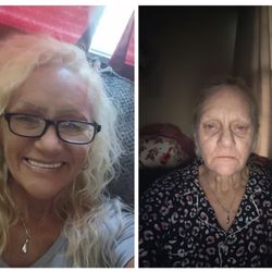 Jim Brantner, M.D. Plastic and Reconstructive Surgery - This photo is a woman who had one breast implant had a ruptured implant in age 25 years and couldn't understand why she was sick