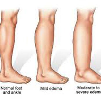 ABC Lymphedema Clinic - Chiropractors Near Me - Bettendorf, Iowa ABC Lymphedema Clinic - Chiropractors Near Me - Bettendorf, Iowa