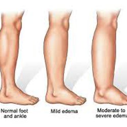 ABC Lymphedema Clinic