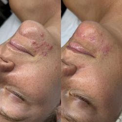 Luxe & Nova - Just 5 weeks into our acne program and she has already seen much improvement with inflammation and less breakouts!