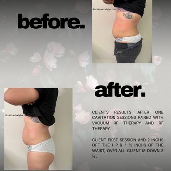 Boutique Body Bar - Before and after photos of client having laser cavitation and laser lipo - Body Contouring Near Me - La Verne, California Boutique Body Bar - Before and after photos of client having laser cavitation and laser lipo - Body Contouring Near Me - La Verne, California