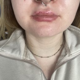 next day with bruising on my top and crazy lip stain they put on lol