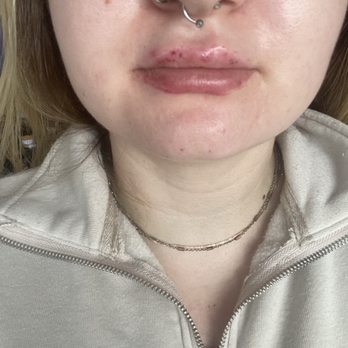 Aesthetic Envy - next day with bruising on my top and crazy lip stain they put on lol - Medical Spas Near Me - Sacramento, California