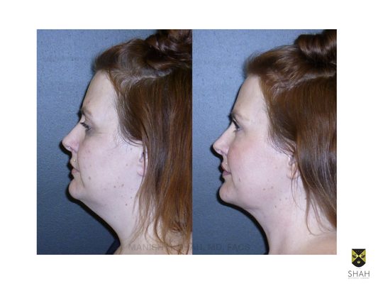 Shah Aesthetic Surgery - Rhinoplasty and Facelift Specialist by null