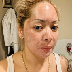 Abby Skin Clinic - Chemical Peel Day 3
