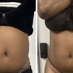 Reje Aesthetics - Body contouring