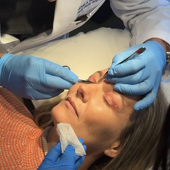 Michael A. Persky, M.D, F.A.C.S - Stitch removal on patient 5 days after having blepharoplasty, upper eyelid surgery. - Cosmetic Surgeons Near Me - Encino, California Michael A. Persky, M.D, F.A.C.S - Stitch removal on patient 5 days after having blepharoplasty, upper eyelid surgery. - Cosmetic Surgeons Near Me - Encino, California