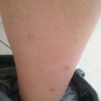 Marin Suites Hotel - Bed bug bites - Hotels Near Me - Corte Madera, California