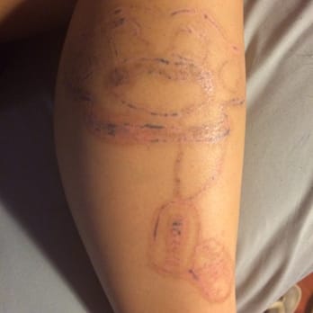 Marta Recasens MediSpa - This is before my treatment #3 - Tattoo Removal Near Me - Glendale, California Marta Recasens MediSpa - This is before my treatment #3 - Tattoo Removal Near Me - Glendale, California