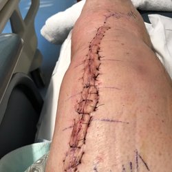 Accelerated Physical Therapy - Knee revision replacement