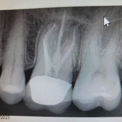 DK Endodontics - My root canal