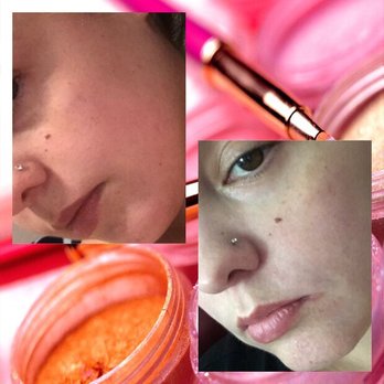 VIDA Aesthetic Medicine - Photos on the left / top are the before s. Photos on the right are afters. - Medical Spas Near Me - Salem, Oregon VIDA Aesthetic Medicine - Photos on the left / top are the before s. Photos on the right are afters. - Medical Spas Near Me - Salem, Oregon