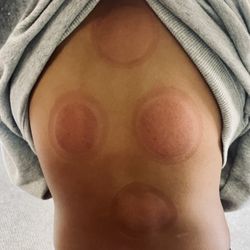 Jenny Zhai Acupuncture - Totally recommend cupping.