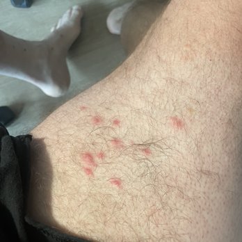 Hampton Inn Greenfield - Bed bug bitted thigh - Hotels Near Me - Greenfield, Indiana Hampton Inn Greenfield - Bed bug bitted thigh - Hotels Near Me - Greenfield, Indiana