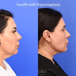 SKY Facial Plastic Surgery - Lower face and neck lift - Right Oblique View