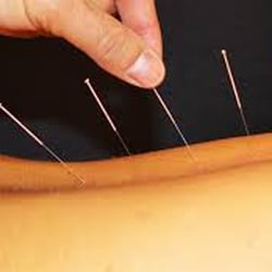 Jennifer Klein Physical Therapy & AATB Pilates - Dry Needling