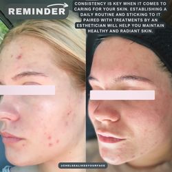Chelsea Likes Your Face - Monthly facials will change you and your skin ‍