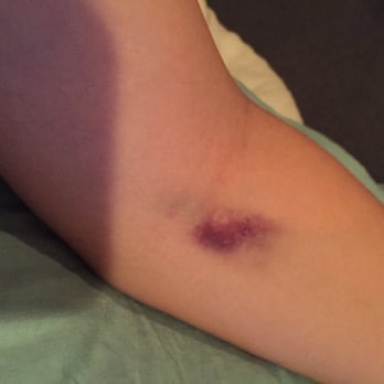 Labcorp - Bruising from butterfly needle. - Laboratory Testing Near Me - Philadelphia, Pennsylvania Labcorp - Bruising from butterfly needle. - Laboratory Testing Near Me - Philadelphia, Pennsylvania