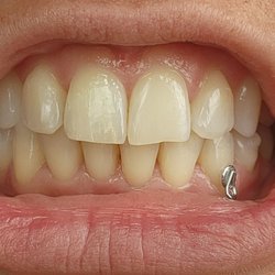 Charleston Orthodontic Specialists - Drilled teeth