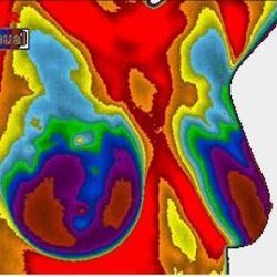 Early Screen Thermography - Breast Thermography
