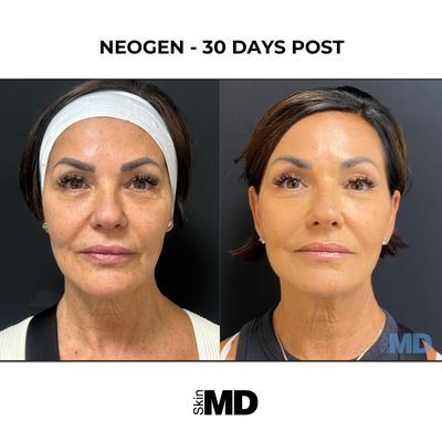 Skin MD Services Overview - Welcome to Skin MD where we use unparalleled technology coupled with medical aesthetic techniques, knowledge, and decades of expertise to build trust, creating happy patients who feel good about how they look and feel.
Skin MD is the Boston area multi-location, top medical spa offering cosmetic face and body treatments plus essential ongoing programs for your complete health and wellness. Our whole-body approach to treating each and every patient means that you will have a wide array of aesthetic services to choose from that will support you from your initial consultation to your first treatment through to your final desired transformation.
At Skin MD, we will do everything in our power to help you achieve your optimal results. This includes offering our patients cutting-edge non-invasive skin rejuvenation treatments, body sculpting procedures, medical-grade skincare products, and more invasive surgical options that can provide dramatic body transformations. It also means that we provide our patients with affordable payment options and interest-free financing through CareCredit for those eligible. Finally, our commitment to 100% patient satisfaction means that we set realistic goals so that you get what you expect from your services. We strive to become your aesthetic and skincare partner and to embark on a lifelong journey together to help you look, feel and be your best.
Services Offered:
Skin Rejuvenation
Dermal Fillers
Dysport / Botox
Morpheus8 - RF microneedling
NeoGen
IPL |Photofacial
1540 Laser
Pico Laser
FaceTite
DiamondGlow Facials
BodySculpting
Emsculpt | Emsculpt NEO
CoolSculpting
BodyTite
Cellulite Treatment - Aveli
Laser Hair Removal
Tattoo Removal
Hair Restoration
Sexual and Wellness Health
Hormone Replacement Therapy
C02Re Intima - Vaginal Rejuvenation
GAINSWave for E.D. Skin MD Services Overview - Welcome to Skin MD where we use unparalleled technology coupled with medical aesthetic techniques, knowledge, and decades of expertise to build trust, creating happy patients who feel good about how they look and feel.
Skin MD is the Boston area multi-location, top medical spa offering cosmetic face and body treatments plus essential ongoing programs for your complete health and wellness. Our whole-body approach to treating each and every patient means that you will have a wide array of aesthetic services to choose from that will support you from your initial consultation to your first treatment through to your final desired transformation.
At Skin MD, we will do everything in our power to help you achieve your optimal results. This includes offering our patients cutting-edge non-invasive skin rejuvenation treatments, body sculpting procedures, medical-grade skincare products, and more invasive surgical options that can provide dramatic body transformations. It also means that we provide our patients with affordable payment options and interest-free financing through CareCredit for those eligible. Finally, our commitment to 100% patient satisfaction means that we set realistic goals so that you get what you expect from your services. We strive to become your aesthetic and skincare partner and to embark on a lifelong journey together to help you look, feel and be your best.
Services Offered:
Skin Rejuvenation
Dermal Fillers
Dysport / Botox
Morpheus8 - RF microneedling
NeoGen
IPL |Photofacial
1540 Laser
Pico Laser
FaceTite
DiamondGlow Facials
BodySculpting
Emsculpt | Emsculpt NEO
CoolSculpting
BodyTite
Cellulite Treatment - Aveli
Laser Hair Removal
Tattoo Removal
Hair Restoration
Sexual and Wellness Health
Hormone Replacement Therapy
C02Re Intima - Vaginal Rejuvenation
GAINSWave for E.D.