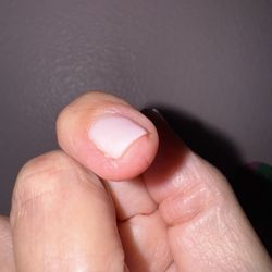 Waterset Nail Bar - Very sore area afterwards due to excessive filing around the nail.