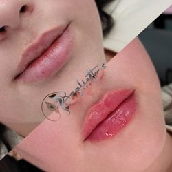 Baglietto's MedSpa - Lipfillers