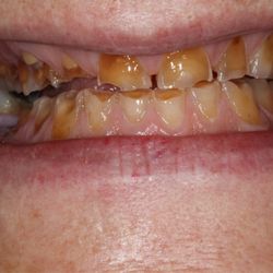 Avi Donitza, DMD - Severe Bruxism & erosion