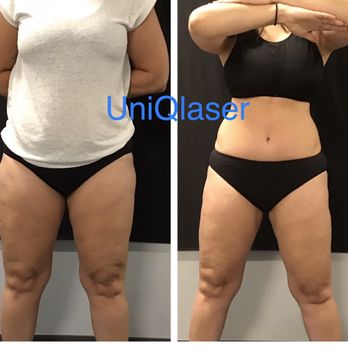 UniQ Laser Center - Another great Coolsculpting result. - Skin Care Near Me - Watertown, Massachusetts UniQ Laser Center - Another great Coolsculpting result. - Skin Care Near Me - Watertown, Massachusetts