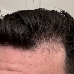 13 months after surgery