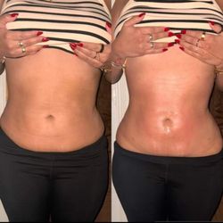Real Bad Boutique - Before and after body cavitation