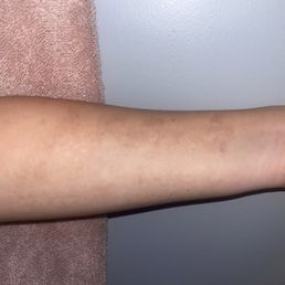 12 sessions later, all that's left is the hyperpigmentation that we are working to get rid of