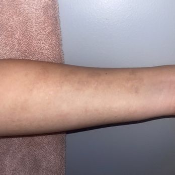 Tattoo Removers Ink - 12 sessions later, all that's left is the hyperpigmentation that we are working to get rid of - Tattoo Removal Near Me - Sherman Oaks, California