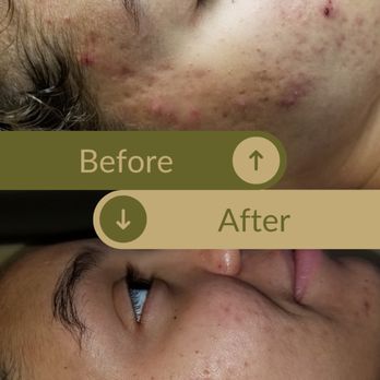 Complexions Clinical Skincare - Clearer skin, Before: inflamed cheeks. After: clearer pores and brighter complexion. - Waxing Near Me - Toledo, Ohio Complexions Clinical Skincare - Clearer skin, Before: inflamed cheeks. After: clearer pores and brighter complexion. - Waxing Near Me - Toledo, Ohio