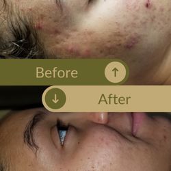 Complexions Clinical Skincare - Clearer skin, Before: inflamed cheeks. After: clearer pores and brighter complexion.
