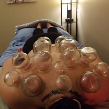 Healing Roots Acupuncture - Cupping by Alyssa! It was so cool! - Acupuncture Near Me - Tustin, California