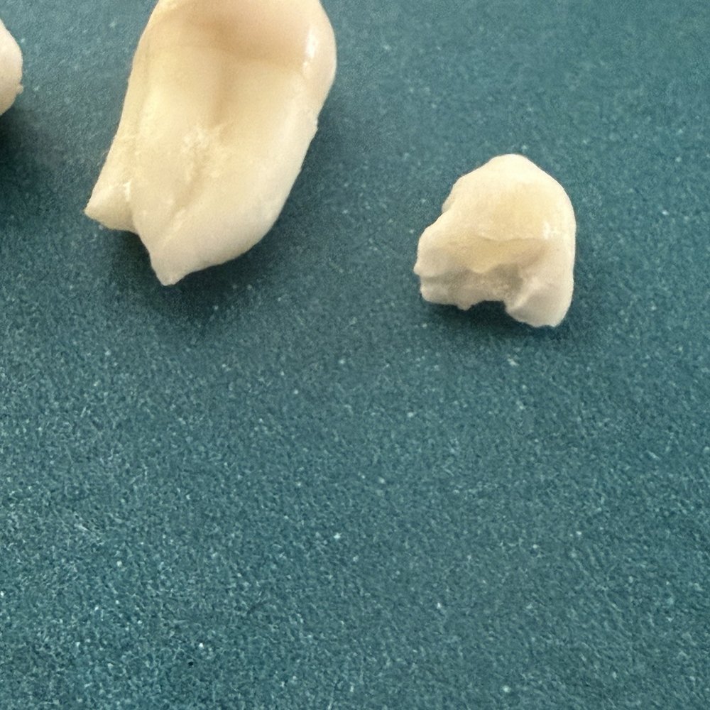 Avia Dental Care - This is what a real oral surgeon removed , thank you Dr. Shelhamer! - Cosmetic Dentists Near Me - Carlsbad, California