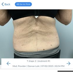 Lucali Aesthetic Medicine - My back before. No shape, crepey skin.