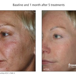 Fountain Of Youth Medical Spa - Before and After of Fraxel Treatments at Fountain of Youth Medical Spa