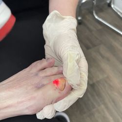 Rejuv Aesthetics - Fully numbed, our client is enjoying pain free laser treatment for her toe fungus#toe-fungus#laser-hair removal#toe-laser#laser-hair-chin