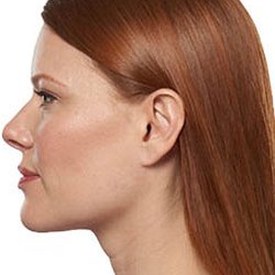 Neck and Chin lift - Mention Yelp!