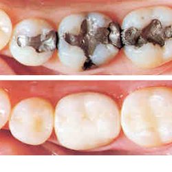 Ready 2 Smile Dental Group - Safe Silver Fillings removal and replacement with Ceramics and Bondings/White Fillings