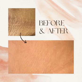 Forever Beauty - Forever Beauty - Tattoo Removal Near Me - Antioch, California Forever Beauty - Forever Beauty - Tattoo Removal Near Me - Antioch, California