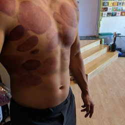 Adpt - Shoulder and ribs feel amazing. Able to breathe better and less shoulder pain. Thanks Corey